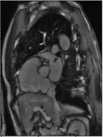 Classifying the orientation of the heart in a series of MRI scan